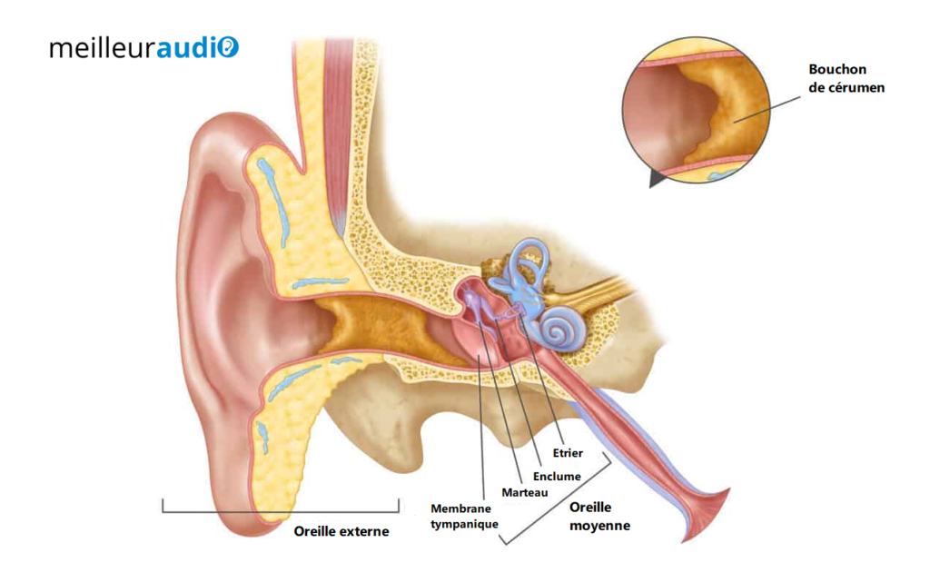 Qu'est-ce qu'un bouchon de cérumen dans l'oreille ?